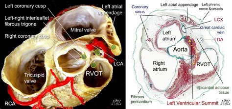 left ventricular summit ablation